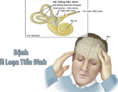 Bệnh tiền đình có thể điều trị khỏi, không phải căn bệnh “trời đày”